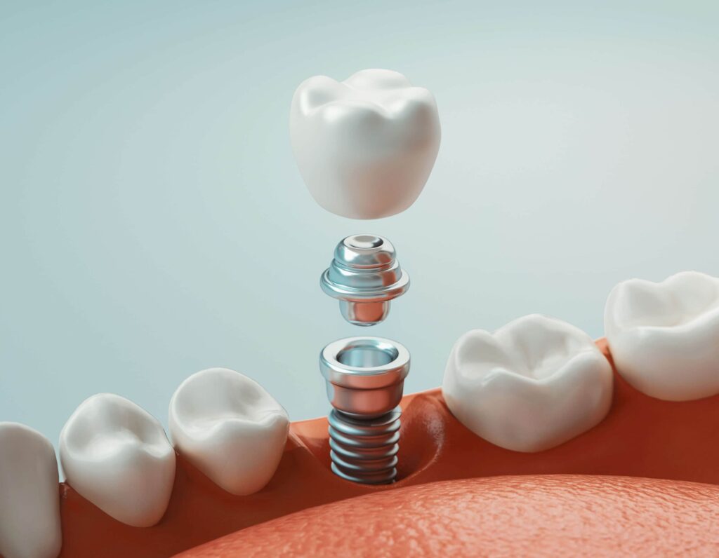 conventional implant and crown trinidad