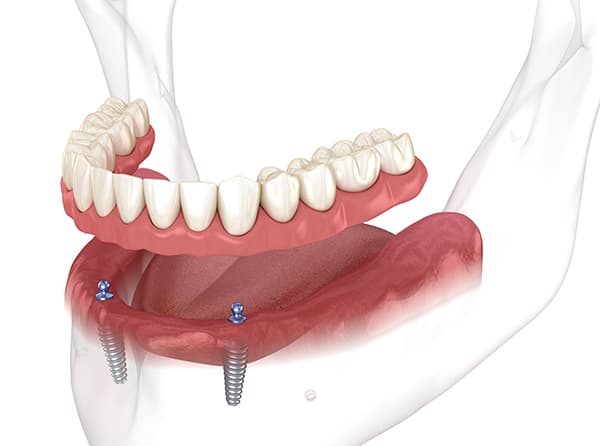 implant retained overdenture trinidad